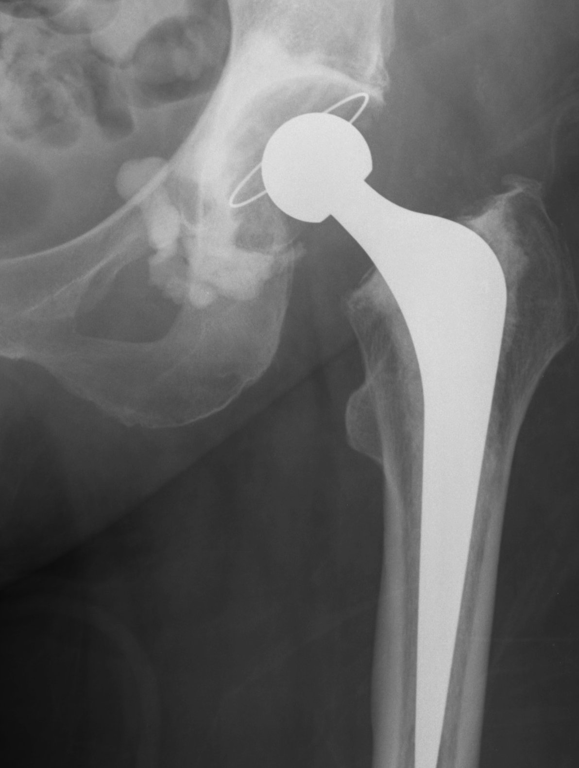 THR Cemented Exeter Inferior Cement Leak